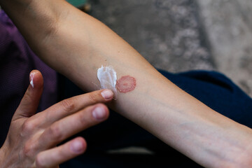Ring Worm infection, Dermatophytosis on skin. Applying an emollient to dry flaky skin