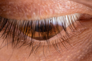 Macro eye photo. Keratoconus 3 degree - eye disease, thinning of the cornea in the form of a cone....