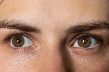 Keratoconus of both eyes, 2nd and 4th degree. Contortion of the cornea in the form of a cone,...