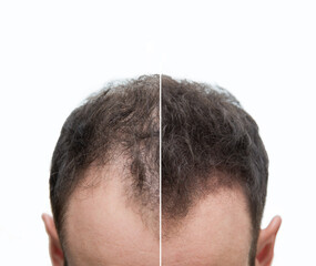 Halbglatze und Geheimratsecken eines Mannes mit Haarausfall - Vorher Nachher - Haarwachstum - Effekt 