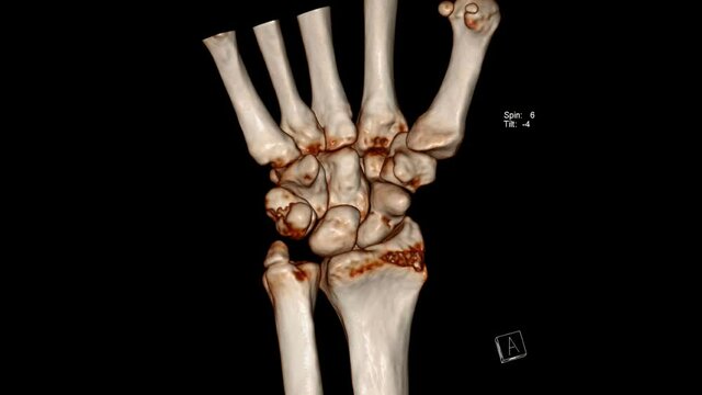 Radiology examination, Computed Tomography Volume Rendering examination of the wrist joint ( CT VR wrist) showing fracture of the scaphoid bone and ulnar styloid process