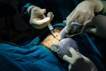 Close up hand of surgeon anesthetic injection in the head making surgery hair transplant on head in...