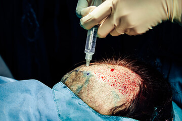 Close up hand of surgeon anesthetic injection in the head making surgery hair transplant on head in...