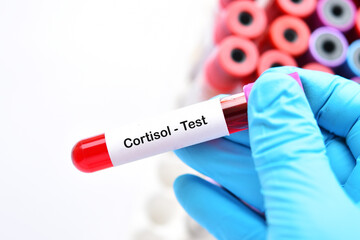 Obraz premium Test tube with blood sample for cortisol hormone test