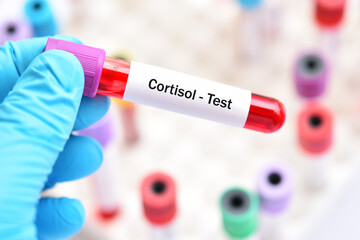 Obraz premium Test tube with blood sample for cortisol hormone test
