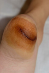 Cut leg. Heel slit. Teenager's leg close-up. Concept of being injured by glass or metal while swimming.