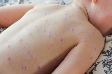 Close-up of a small child with chickenpox virus or chickenpox bubble in a hurry