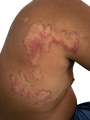 close up of back skin fungal infection , tinea corporis