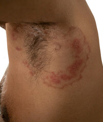 Fototapeta premium close up of axillary skin fungal infection , tinea corporis
