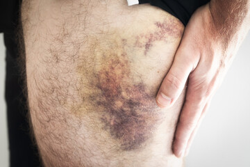 man with big bruise on the thigh. big bruise with bandage. Big blue spot