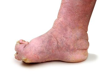 Patients feet of an old man.Inflammatory process.Gout.Erysipelas.Nail fungus.