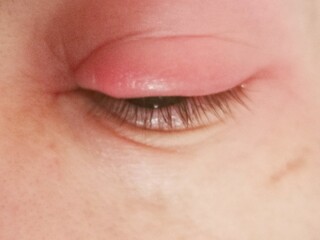 Close up abscess in the eye. hordeolum. stybarley on the eye. inflammation. stye