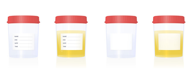 Specimen cups with blank labels and red screw caps - empty and filled with urine. Isolated vector illustration on white background.
