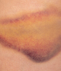 Fototapeta premium Closeup bruise on human skin as a background.