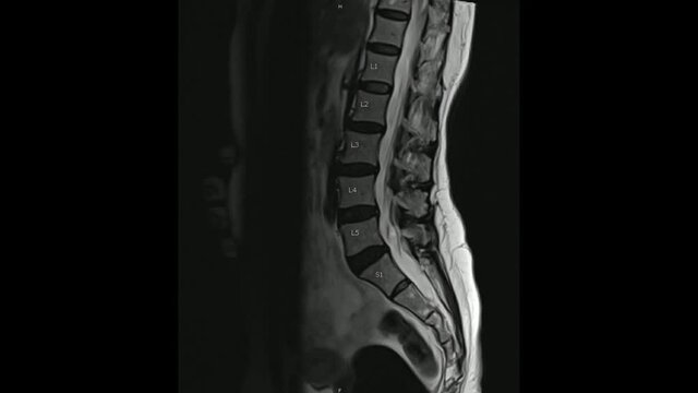 Magnetic Resonance images of Lumbosacral spine sagittal T2-weighted images in Cine mode (MRI Lumbosacral spine).
