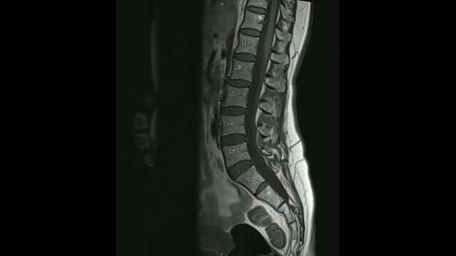 Magnetic Resonance images of Lumbosacral spine sagittal T1-weighted images in Cine mode (MRI Lumbosacral spine).