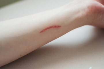 Hand with a cut, wound treatment, medical instruments for a wound