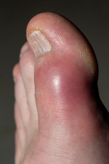 The swelling and redness experienced in the large toe due to Gout and Uric Acid