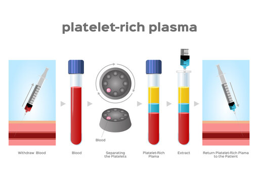 Platelet-Rich plasma procedure stages / prp / Centrifuge vector