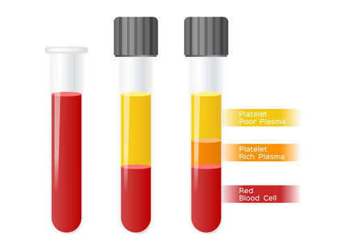 Platelet-Rich plasma procedure stages / prp / Centrifuge vector