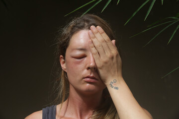 Young caucasian woman with a swollen eye from a wasp's sting. Allergy reaction on wasp bite.	