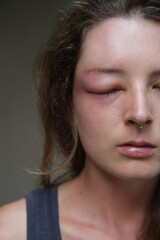 Young caucasian woman with a swollen eye from a wasp's sting. Allergy reaction on wasp bite.	
