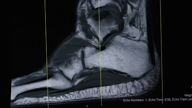 Camera pans across an MRI results screen of a patients right ankle