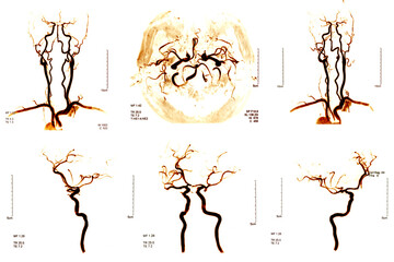 Cerebrovascular in the brain