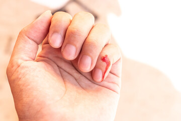 blood on finger human Injured finger with bleeding open cut.