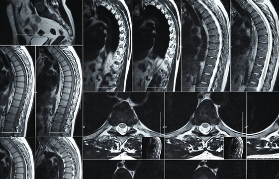 MRI or CT scan of human lumbar spine