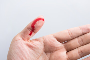 Bleeding blood from the cut finger wound. Injured finger with bleeding open cut wound. Closeup of finger human hand is cut hurt bleeding with bright red blood. 