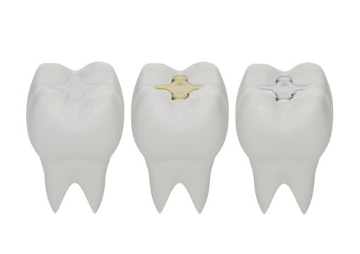 Teeth with gold, amalgam and composite inlay dental filling. Different types of fillings, 3d render