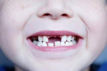 Little boy smiling with the fall of the first baby teeth.