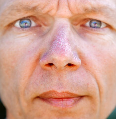 Man with peeling sunburned nose