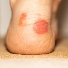 Fototapeta premium Big bloody callus on woman's heel