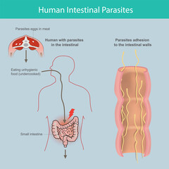 Human Intestinal Parasites. Illustration explain the parasites  in human small intestine from cause of eating infected meat or parasites eggs in meat undercooked before eat..