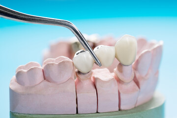 Closeup / Prosthodontics or Prosthetic / Tooth crown and bridge implant dentistry equipment and...