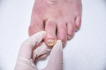 Podiatrist treating feet during procedure, examines the foot. Professional medical pedicure....