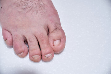 Male nails destroyed by onycholysis. Damage to the male foot nails. At the dermatologist doctor....