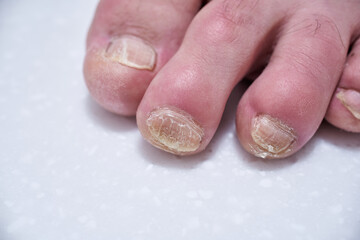 Male nails destroyed by onycholysis. Damage to the male foot nails. At the dermatologist doctor....