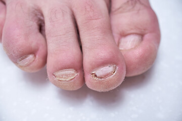 Male nails destroyed by onycholysis. Damage to the male foot nails. At the dermatologist doctor....
