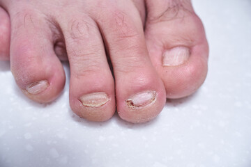 Male nails destroyed by onycholysis. Damage to the male foot nails. At the dermatologist doctor....