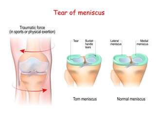 tear of a meniscus. Torn meniscus.