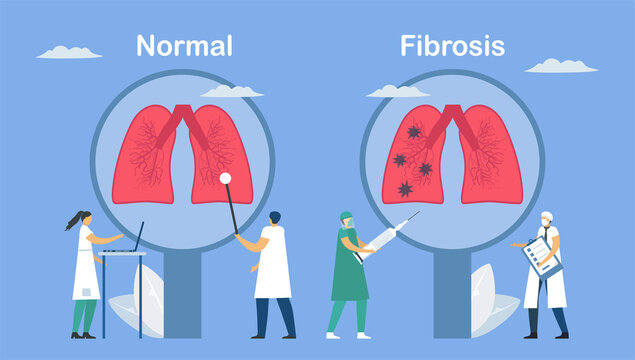 Pulmonary Fibrosis Is A Part Of Restrictive Lung Disease. Lung Tissue Becomes Damaged And Scarred. Comparison Of Normal And Bad Symptom, Respectively. Pulmonology Vector Illustration.