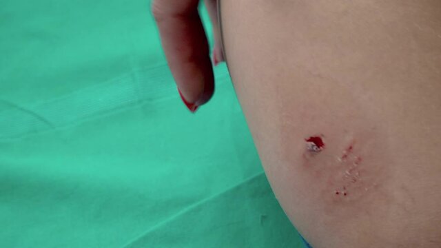 Hospital first aid cleaning of infected dog bite wound on leg of woman