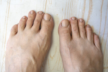 bare feet of caucasian female in bad condition, dry unhealthy toes with dirty damaged nails