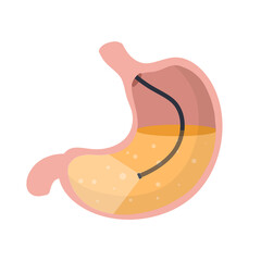 Gastroscopy. Endoscopy and digestive problems. Hose with camera. Procedure with internal organs. Cartoon flat illustration. Medical Visual inspection of stomach