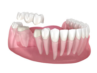 Dental bridge of 3 teeth over molar and premolar. Medically accurate 3D illustration of human teeth treatment