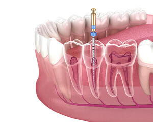 Endodontic root canal treatment process. Medically accurate tooth 3D illustration.