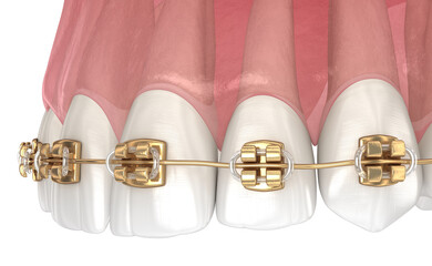 Golden braces tretament, macro view. Medically accurate dental 3D illustration